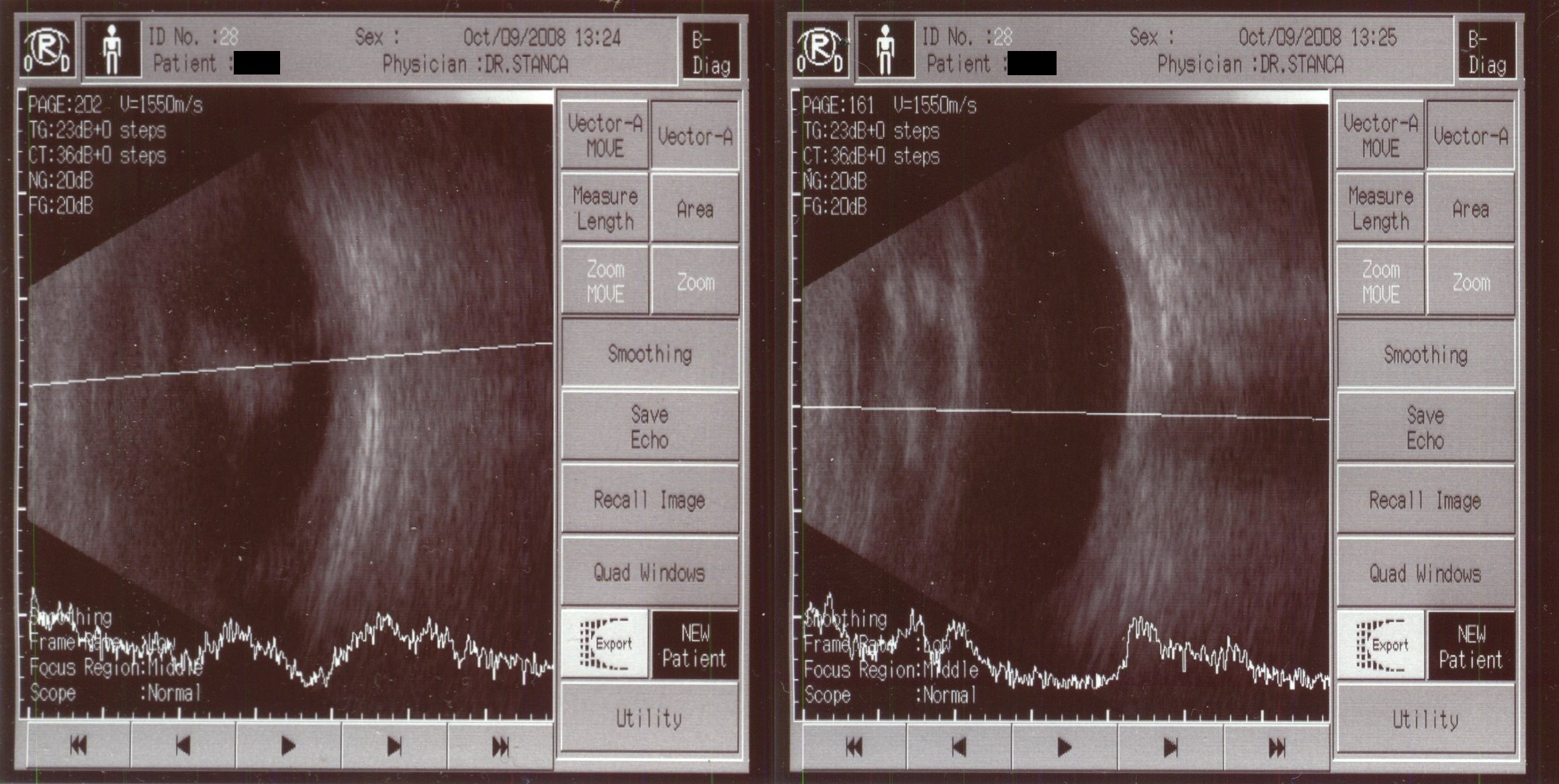 Ecography scan for the Right Eye