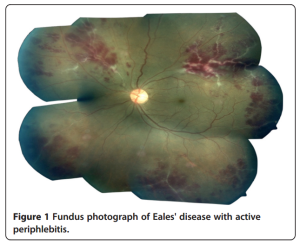 Eye fundus photograph of Eales disease with active periphlebitis